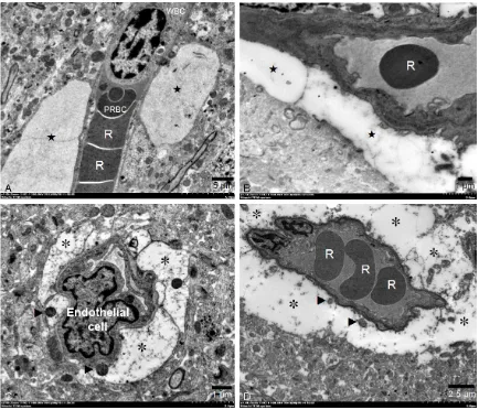 Figure 2. Electron micrographs of perivascular edema and astroglial dilatation. Perivascular edema (★), A: CM and B: non-CM