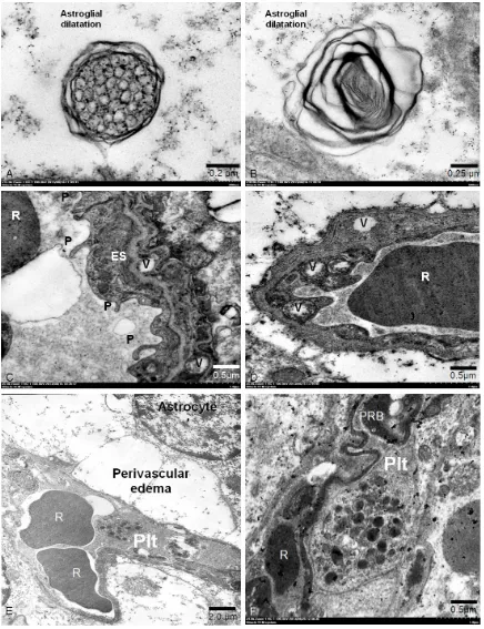 Figure 3. Fine morphological structure of secondary lysosome. A: A multivesicular body is round to oval contain-ing more small vesicles and limited by a double membrane