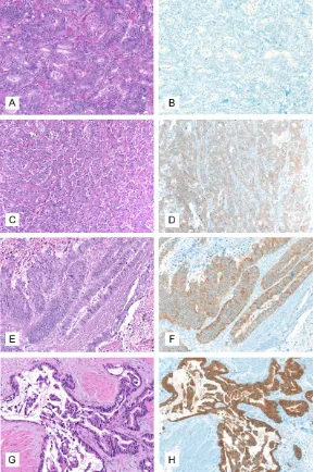 Figure 1. IMP3 staining intensity in gastric adenocarcinomas, 200x magnifi-cation. A, B: IMP3 staining intensity grade 0 (A: HE, B: Immunohistochemistry with IMP3); C, D: IMP3 staining intensity grade 1 (C: HE, D: Immunohisto-chemistry with IMP3); E, F: IMP3 staining intensity grade 2 (E: HE, F: Immu-nohistochemistry with IMP3); G, H: IMP3 staining intensity grade 3 (G: HE, H: Immunohistochemistry with IMP3).