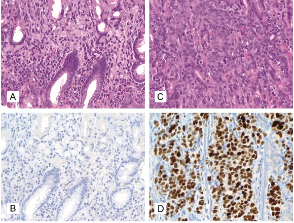 Figure 2. p53 staining score in gastric adenocarcinomas, 400x magnifica-tion. A, B: Score 0, negative (A: HE, B: Immunohistochemistry with p53); C, D: Score 1, positive (C: HE, D: Immunohistochemistry with p53).