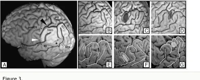 Figure 3. Example  of  natural  morphological  variability:  left  inferior  parietal  lobule  (IPL;  ﬁgure  from[Kiriyama et al