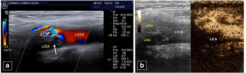 Fig. 13 A 74-year-old malepatient with bilateral leg deepvenous thrombosis history andIVC filter