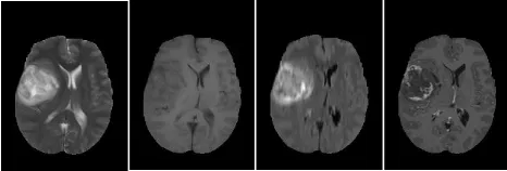 FIGURE 1. Samples of four abnormal(pathological) MRI slices, from leftto right T2-w, T1-w, FLAIR and T1c-w.