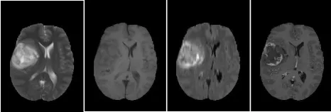 FIGURE 1. Samples of four abnormal(pathological) MRI slices, from leftto right T2-w, T1-w, FLAIR and T1c-w.