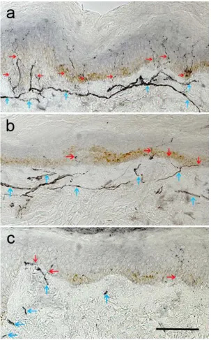 Fig. 3: Immunohistochemical study (neuronal marker PGP9.5) in sections from skin biopsies from dorsum of the foot from a healthy subject (a), a patient with T1 diabetes without neuropathy (b), and with neuropathy (c)