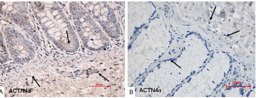 Figure 2. Immunohistochemical staining of BMPR1α. A: The mucous layer and the muscular layer of stenotic colon segment (The staining of BMPR1α were brown yellow); B: The mucous layer and the muscular layer of normal colon segment (The staining of BMPR1α were light yellow or colorless) (original magnification × 400).