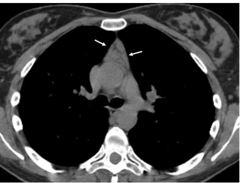 Fig. 16 Thymic lymphoid hyperplasia in a 41-year-old woman withclinical diagnosis of myasthenia gravis