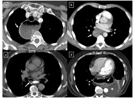 Fig. 4 Thymolipoma in a 47-that has extensive fat contentand contains small amounts ofyear-old asymptomatic man.Axial and coronal multiplanarreconstruction of non-contrast-enhanced CT scan show a largeand well-defined mass (arrows)thin fibrous septa