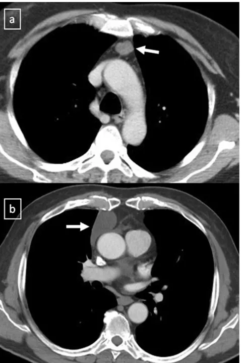 Fig. 5 A well-marginated mass with a homogeneous attenuation,usually in the range of water attenuation (0–20 HU) and without anenhancement of the wall or infiltrative appearance are the typicalfeatures of benign mediastinal cysts