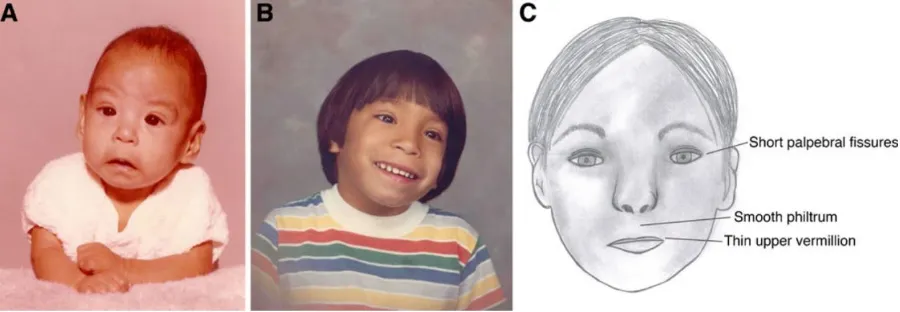 Figure 2.1: FAS facial features. From Riley, Infante & Warren (2011) 