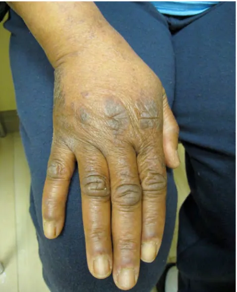 Figure 2. Shawl sign: Poikiloderma skin changes on the upper back.