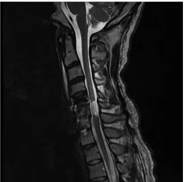 Figure 2. Sagittal cervical spine CT���������������������������