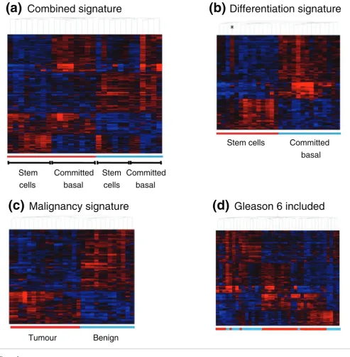 Figure 1Distinctive stem cell and tumor signatures are found in human prostate cancers containing a minimum Gleason score 7 pathology