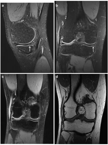 Fig. 1 A 21-year-old male witha surgically confirmed normalmedial meniscus, which wasinterpreted as a meniscal tear byall readers using 3D SPACEand as a normal meniscus by allreaders using the routine MRprotocol