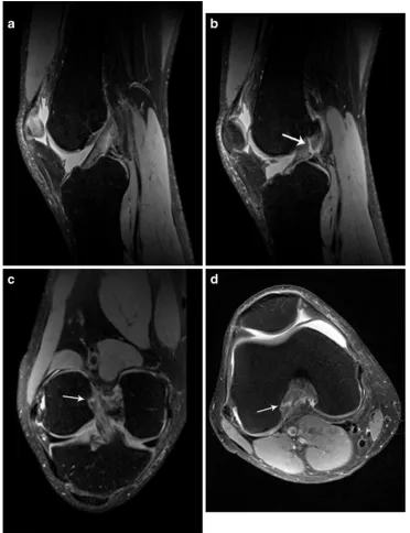 Fig. 2 A 53-year-old malewith a surgically confirmedtear of the posterolateral (PL)bundle of the ACL, whichwas correctly identified by allreaders using both 3DSPACE and the routine MRprotocol