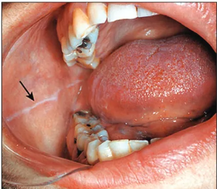 Figure 7.  Linea Alba. Example of a linea alba in the patient’s cheek.