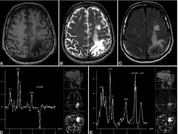FIGURE 3. (A) Axial T1-weighted [T1W], (B) T2W, and (C) fluid-attenuated inversion recovery (FLAIR) images showed a large T1Whypointense lesion, and a T2W and FLAIR hyperintense lesion in the left parietal and frontal lobes, consistent with progressive mul