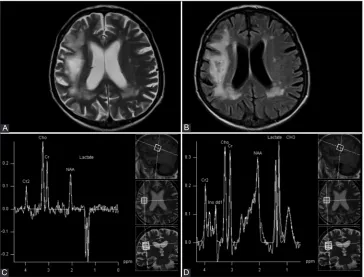 FIGURE 4. Atense on (A) T2W and (B) fluid-attenuated inversion recovery (FLAIR) images, with a sharp border toward gray matter, typical for progres-sive multifocal leukoencephalopathy