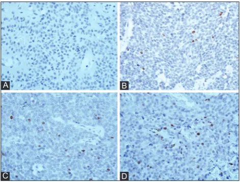 FIGURE 1. Histopathological features of pituitary adenomas: (A) solid pattern (B) trabecular pattern (C) mixed pattern (D) papil-lary pattern (Hematoxylin and eosin staining, magnification ×20).