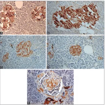 FIGURE 5. Islet amyloid polypeptide (IAPP) immunocytochemical staining for control (A) and Type 2 diabetes mellitus (T2DM) islets, Case 10 (B-D) and Case 14 (E) IAPP immunostaining was performed using 1:400 for control islets (A) and using 1:200 dilution f