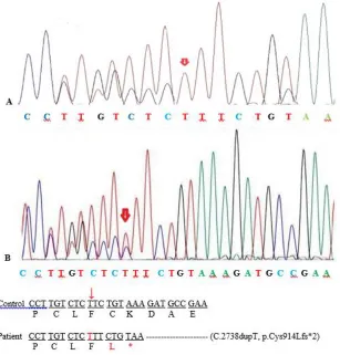 Fig. 2: Partial DNA sequence of ASPM gene. The sequence chromatograms showed the homozygous mutation c.2738dupT in the patient (A) and the heterozygous mutation in the parents (B) 
