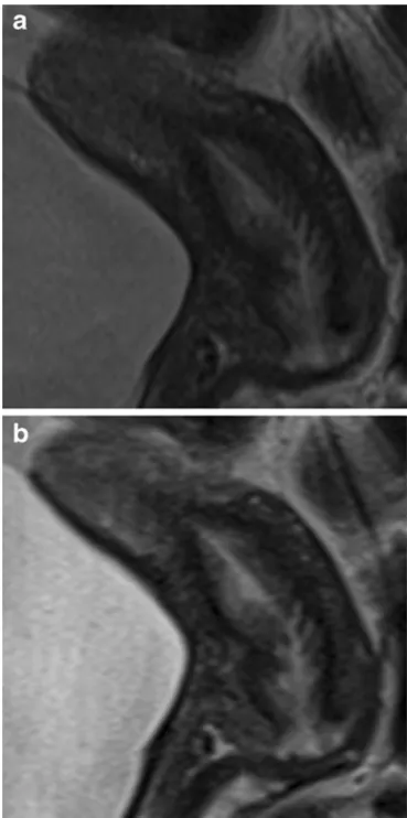 Fig. 4 MRI of a 48-year-old patient with histologically confirmedsactosalpinx of the left side