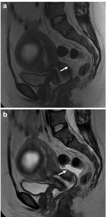Fig. 5 MRI in a 37-year-old patient with necrotic intramural leio-myoma. a T2-weighted BLADE sequence