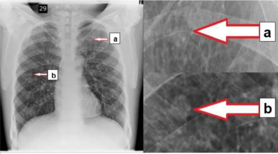 Figure 1. An example of a Lungman chest phantom image illustrating the two simulated lesions 