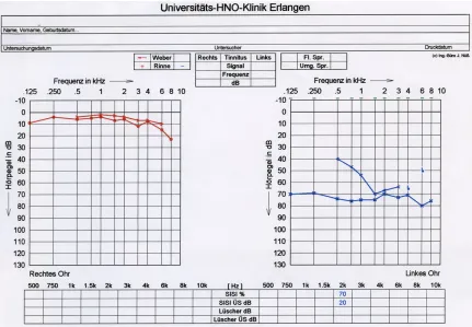 Figure 1. The audiogram at first presentation, showing severe pantonal combined hearing loss up to 75 dB, with a conductive component of up to 30 dB at 500 Hz.