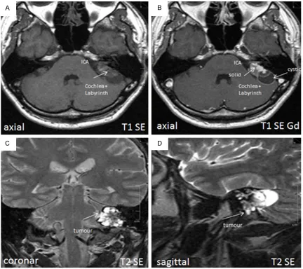 Figure 2. (A) T1 SE axial magnetic resonance imaging (MRI), showing the internal carotid artery (ICA) and the co-chlea and labyrinth infiltrated by tumor; (B) and T1 SE gadolinium MRI, showing solid and cystic parts of a tumor 3.5 × 1.8 × 2.5 cm in size in