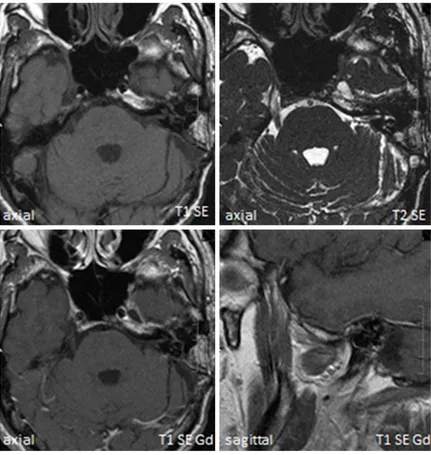 Figure 4. There were no signs of tumor recurrence at the most recent magnetic resonance imaging follow-up exami-nation (in April 2013)