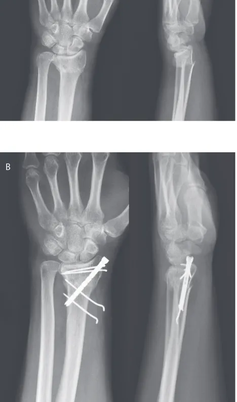FIGURE 1.  A type A3 fracture of the distal radius. Postero-anterior and lateral radiographs of the fracture (patient B.N.) A) after injury; B) at 3 months after intramedullary X-screw fi xation.