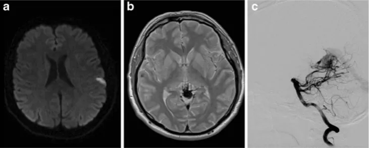 Fig. 2 A 20-year-old female with sudden onset of neurological symp-diffusion that would be characteristic for an acute ischemic stroke.Encephalitis was proven by CSF examination