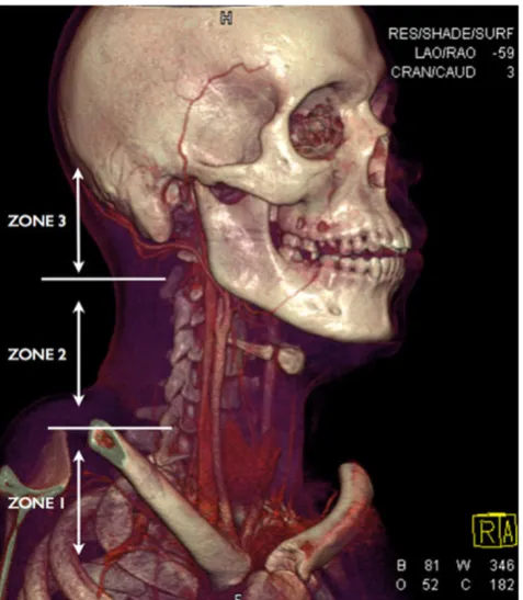Fig. 1 Three-dimensional volume rendering technique (3D VRT) ofMDCTA performed on a young male victim of a stab wound to theneck demonstrating the anatomical trauma zones in penetrating injuryof the neck
