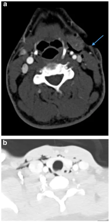 Fig. 2 a Axial image of MDCTA performed on a 33-year-old manwho sustained a stab injury to left zone 2