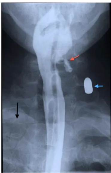 Fig. 8 a Axial MDCTA image through the junction of the nasophar-performed 2 days later, demonstrating severe generalised hypoxicischaemic encephalopathy with symmetrical subacute low attenuationchange identified in the basal ganglia at this level as well a