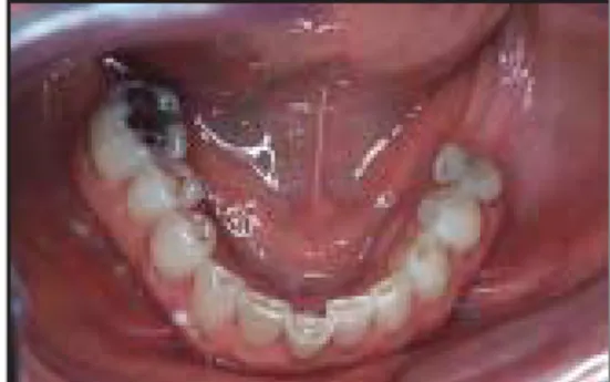 Figure 1. Shortened dental arch.