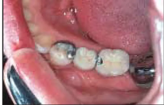 Figure 7. Hybrid bridge replacing /5 using a combination of resin-bonded and conventional retainers