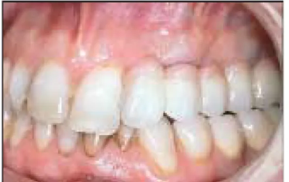 Figure 10. Implants used to replace congenitally absent 3/3.