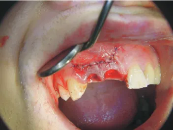 Figure 4. Condition of the socket and papilla after extraction of teeth. (Courtesy of Dr Marius Steigman).