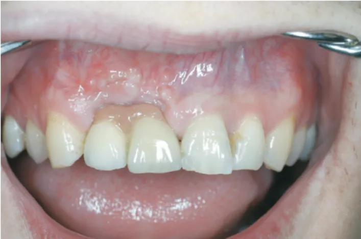 Figure 6. Implants failed to match the esthetics associated with natural teeth.