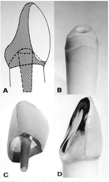 Figure 10-6  Excellent example of a crown ferrule that is extensive enough to strengthen the post crown in place