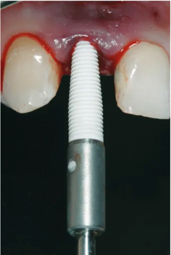 Fig. 10. Initial drilling with a 2-mm twist drill and a direction aid.