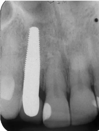 Fig. 20. Standardized periapical radiograph after crown placement.