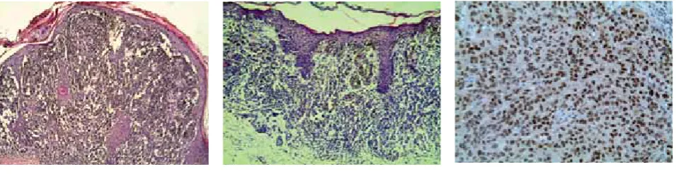 FIGURE 1.  Malignant melanoma of the skin, nodular type (H&E, x20).