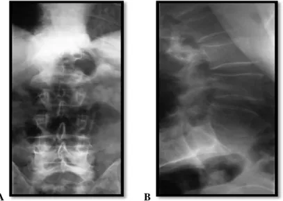 Fig. 2. Lumbar column X-ray,: A – anterior-posterior view, B – lateral view 