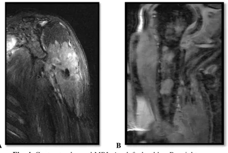 Fig. 4. Contrast enhanced MRI: A – left shoulder; B – right arm. 