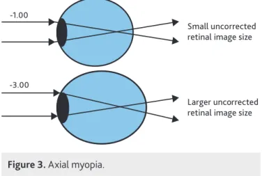 Figure 3. Axial myopia.