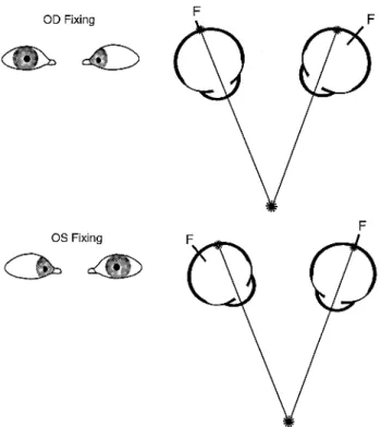 FIGURE 3-11. Alternating esotropia. Top diagram: right eye is ﬁxing and the image is aligned with the right fovea while the image falls nasal to the left fovea as the left eye is deviated
