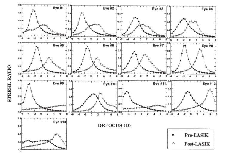 Figure 5. Strehl ratio as a function of defocus (relative to Z 0 2 = 0) for all eyes in this study